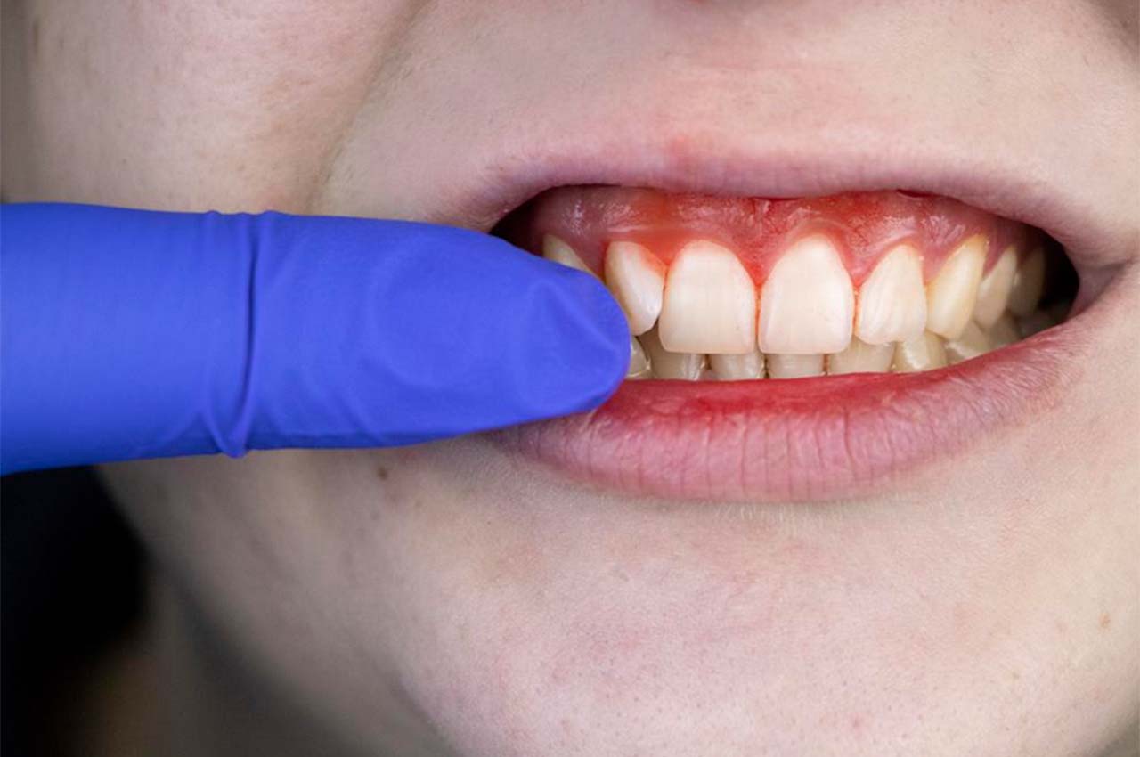 Diş Eti Kanaması - Nedenleri, Belirtileri ve Tedavisi